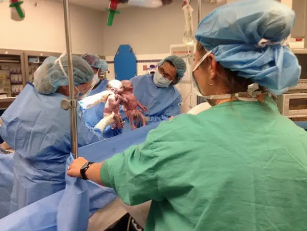Both-hands-were-the-twin-birth-photos