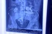 محتویات شکم این مرد همه را انگشت به دهان کرد/ عکس