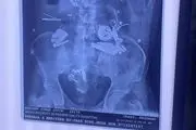 محتویات شکم این مرد همه را انگشت به دهان کرد/ عکس
