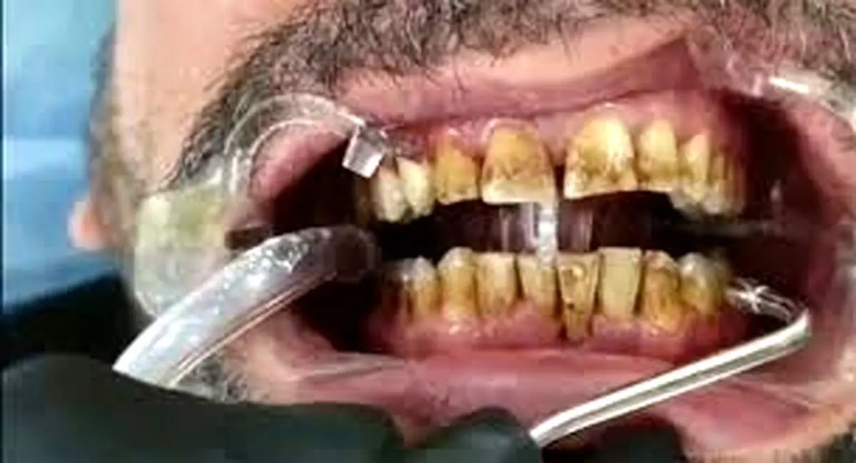 روش‌های خانگی برای محو کردن جرم دندان