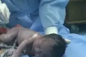 خروج چهار دست و پای نوزاد از شکم مادرش هنگام سزارین !+ عکس