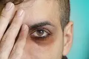 دلیل تیرگی دور چشم چیست؟ 