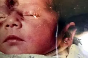 خال مادرزادی زشت این دختر جوان او را معروف کرد! +عکس