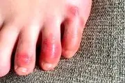 التهاب انگشتان پا از علایم کرونا است؟