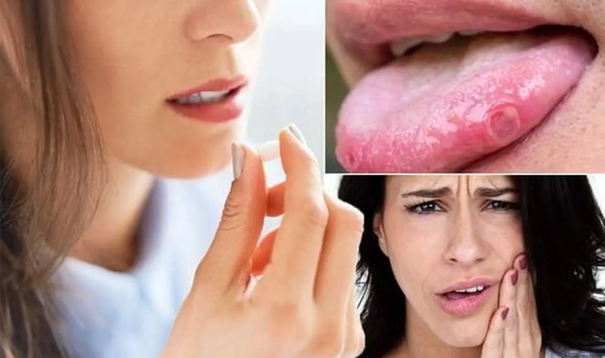درمان سه سوته زخم‌های دهان