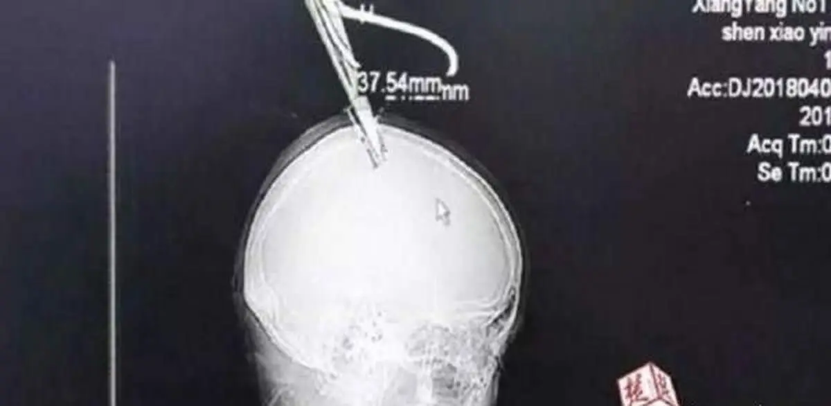 حرکت باورنکردنی یک زن با قیچی داخل سرش! + عکس
