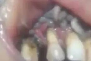 بارش چندش آور کرم زنده از دهان این زن بیچاره! / فیلم 18+