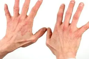 اگر این نشانه‌ها را در انگشتان خود داردی یعنی به دیابت مبتلا شده‌اید