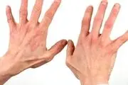 اگر این نشانه‌ها را در انگشتان خود داردی یعنی به دیابت مبتلا شده‌اید