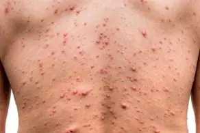چند کشور درگیر آبله میمونی شدند؟