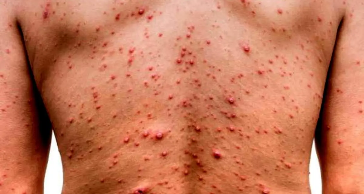 چند کشور درگیر آبله میمونی شدند؟