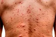 چند کشور درگیر آبله میمونی شدند؟