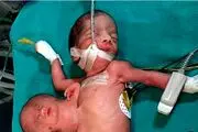 هشدار؛ دیدن این تصاویر دلخراش از نوزاد دو سر بعد از جداسازی به شما توصیه نمی شود/عکس

