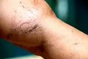 روش جدید درمان واریس را بشناسید