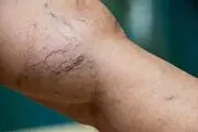 روش جدید درمان واریس را بشناسید