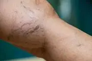 روش جدید درمان واریس را بشناسید