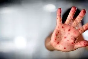 علل افزایش بروز «آبله‌مرغان» در ایران مشخص شد + جزئیات