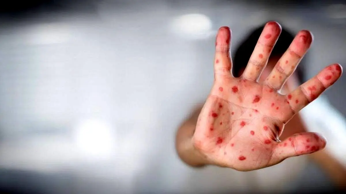 آمار مبتلایان آبله میمون سر به فلک کشید