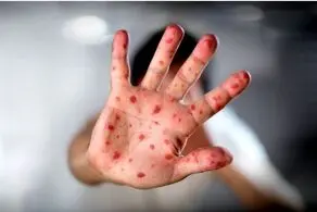 شیوع شدید ابتلا به سرخک در این منطقه