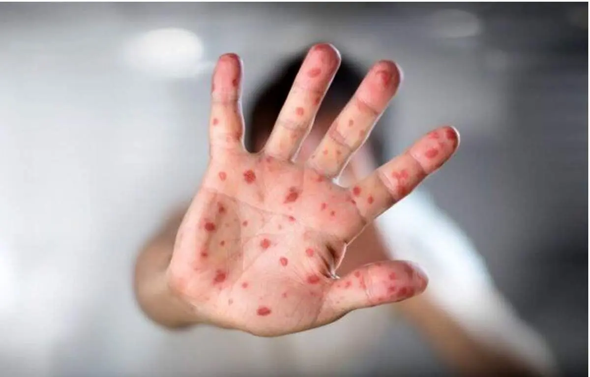 شیوع شدید ابتلا به سرخک در این منطقه