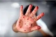 شیوع شدید ابتلا به سرخک در این منطقه