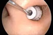 خارج کردن دردناکه جسم عجیب از بینی نوزاد + عکس