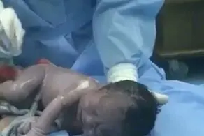 لحظه عجیب فرار نوزاد از شکم مادرش حین زایمان!+ عکس