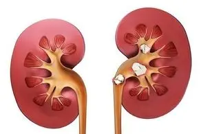 با بهترین سنگ شکن کلیه آشنا شوید