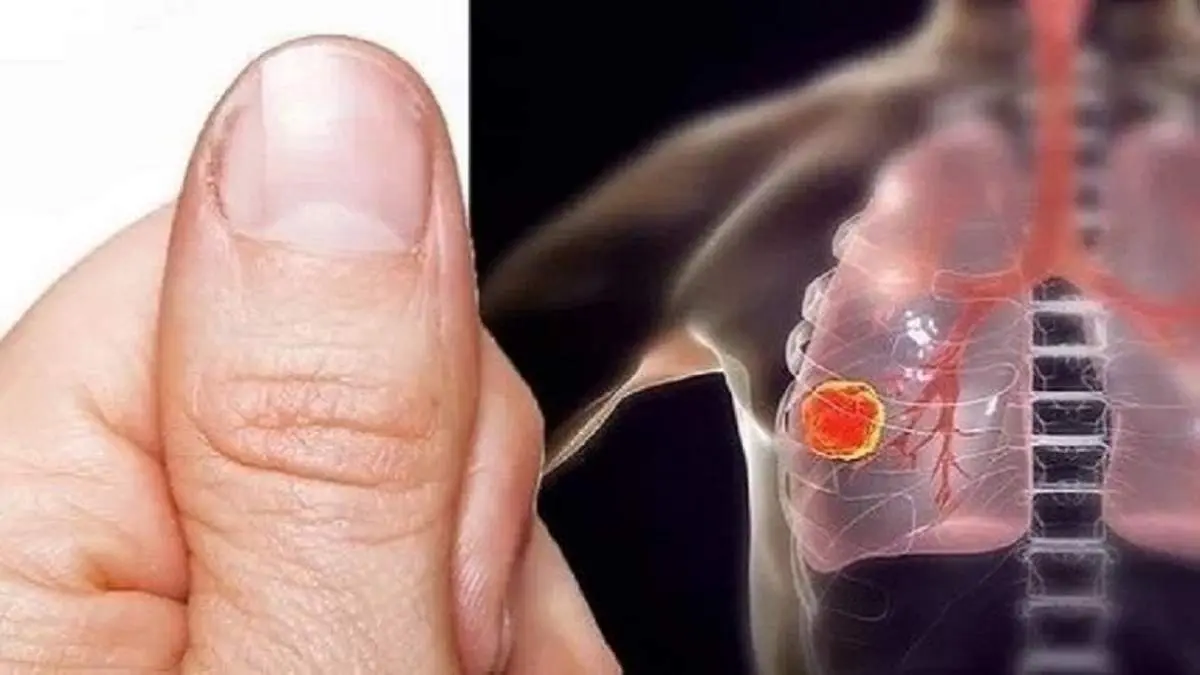 تغییر شکل انگشتان، نشانهای از یک بیماری جدی و کُشنده