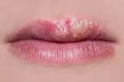 نابودی تبخال به روش مادر بزرگ‌ها
