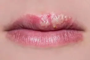 نابودی تبخال به روش مادر بزرگ‌ها