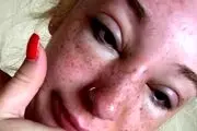 بدبخت شدن زن جوان پس از استفاده از روغن برنزه کننده! + عکس