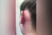 نتیجه دلخراش پیرسینگ دختر جوان+ عکس