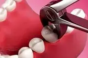 با عوارض نکشیدن دندان عقل نهفته آشنا شوید
