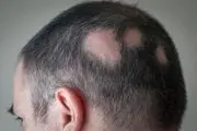 یک گونه قارچی جدید ایجادکننده کچلی در ایران یافت شد