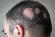 یک گونه قارچی جدید ایجادکننده کچلی در ایران یافت شد