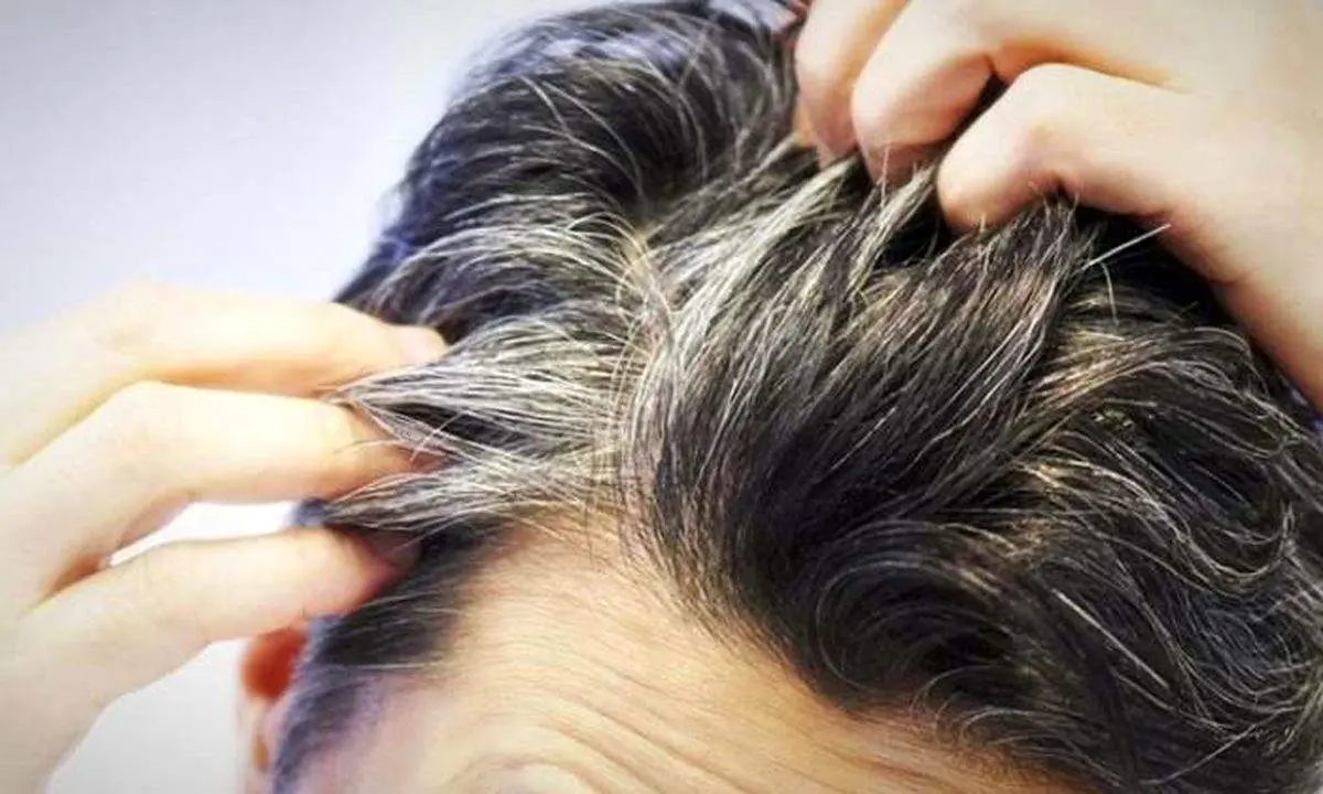 شوره سر میتواند علامت این بیماری خطرناک باشد