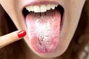 بیماری خطرناکی که علامتش روی زبانتان است