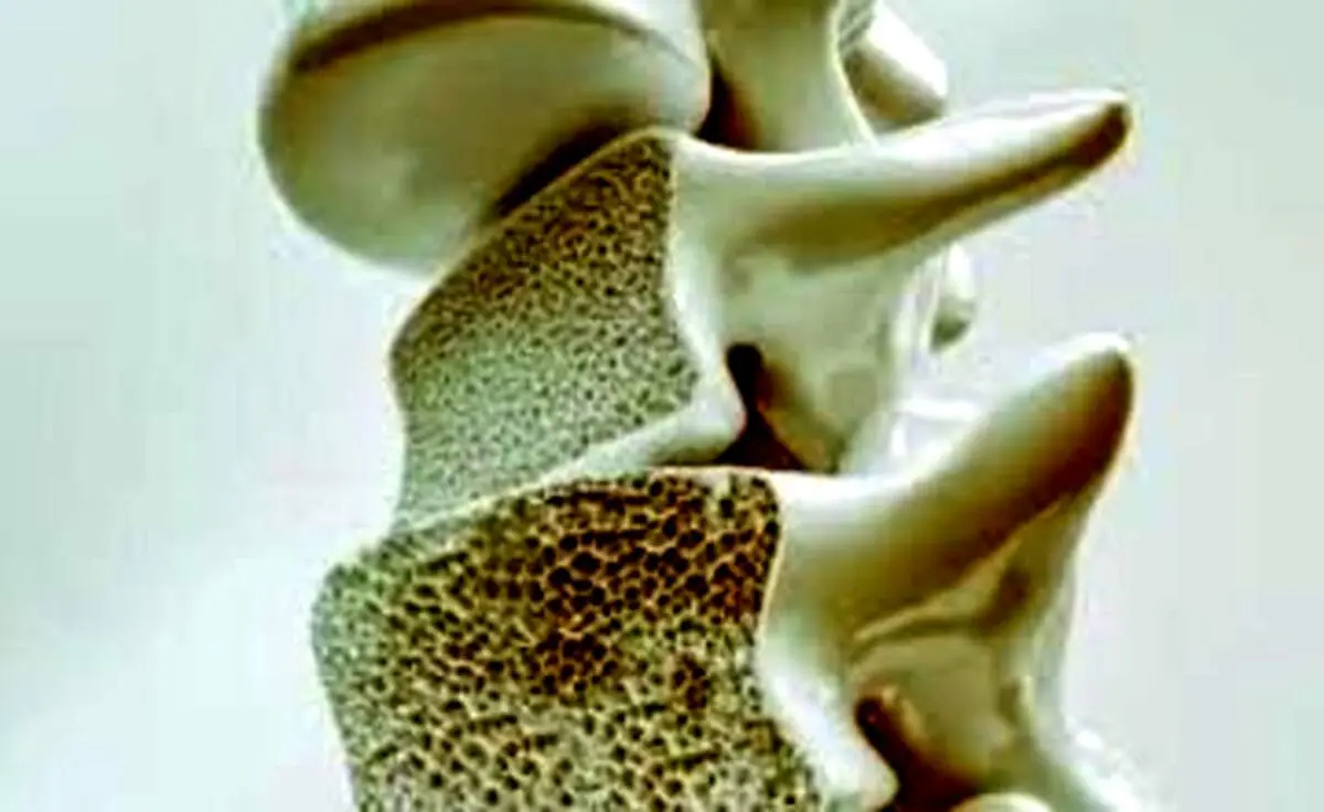 این علائم یعنی استخوان‌ های شما پوک می‌شود