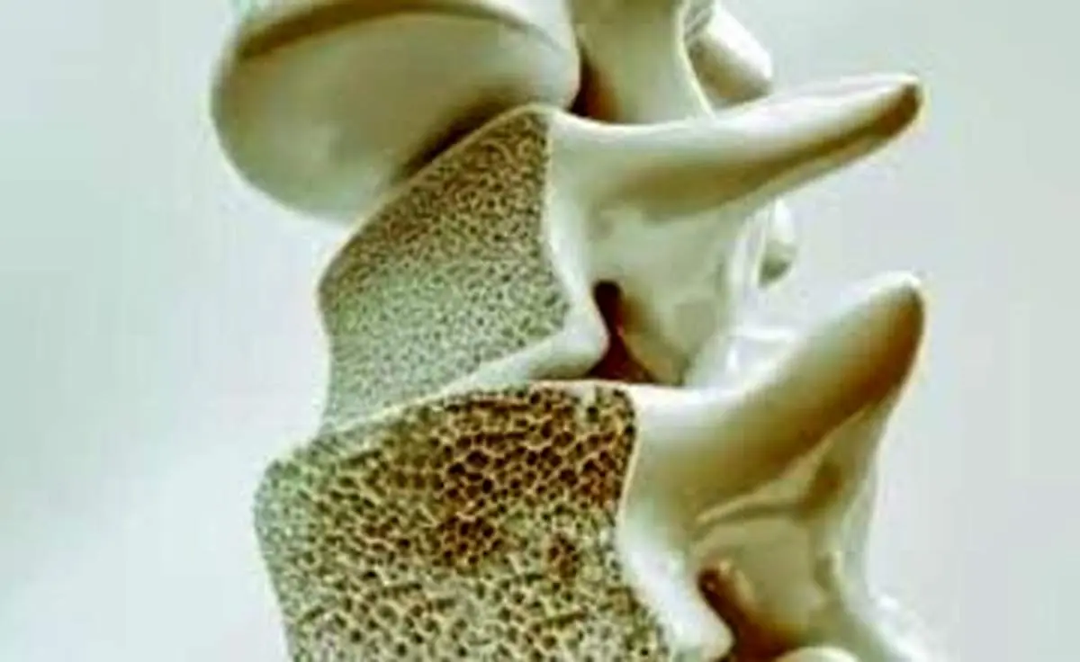 این علائم یعنی استخوان‌ های شما پوک می‌شود