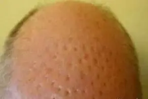 جراحی زیبایی موی سر کار دست مرد کچل داد +عکس