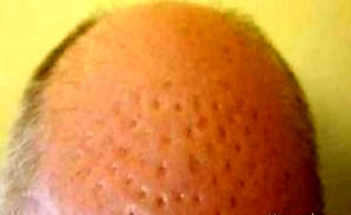 جراحی زیبایی موی سر کار دست مرد کچل داد +عکس