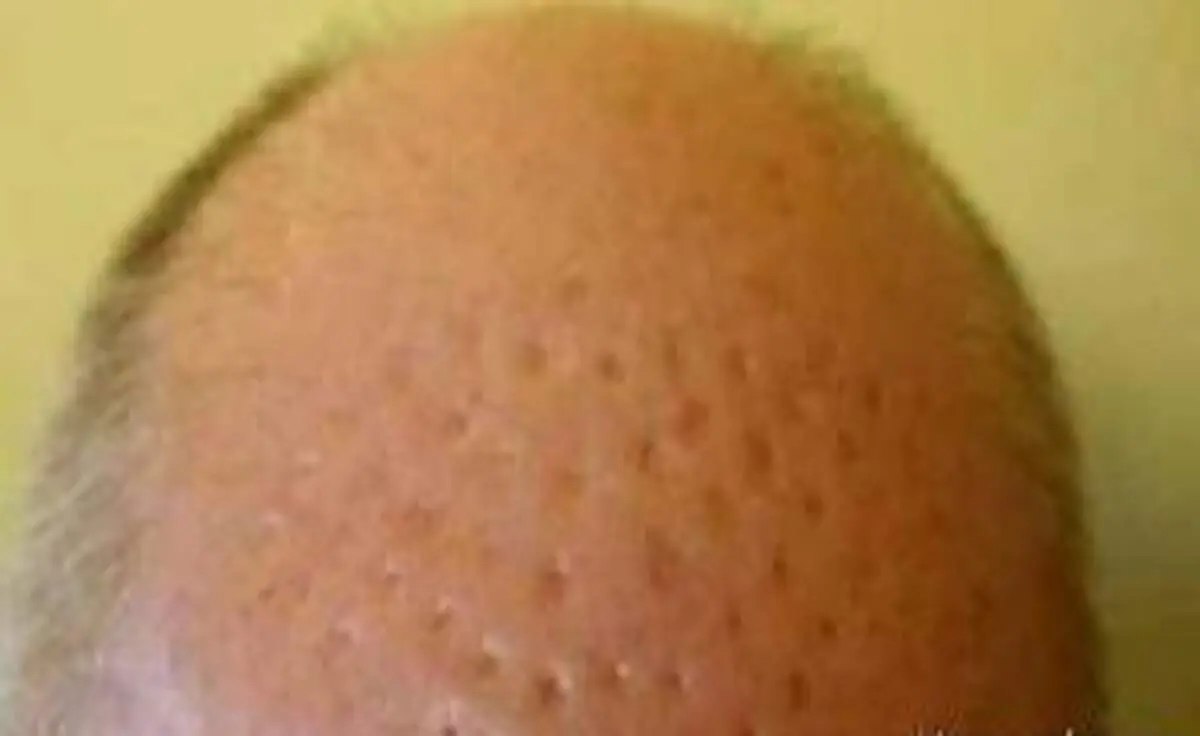 جراحی زیبایی موی سر کار دست مرد کچل داد +عکس