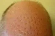 جراحی زیبایی موی سر کار دست مرد کچل داد +عکس