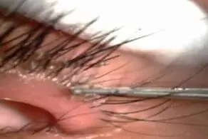 ده‌ها شپش چندش‌آور در چشمان این دختر بچه بیچاره لانه کردند!+ عکس