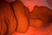 روش شگفت انگیز ۴ هفته‌ای پاکسازی روده برای لاغری
