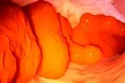 روش شگفت انگیز ۴ هفته‌ای پاکسازی روده برای لاغری