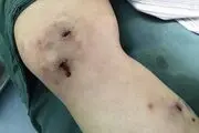 منفجر شدن پوست دختر بخت برگشته!+ عکس