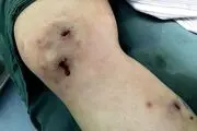منفجر شدن پوست دختر بخت برگشته!+ عکس