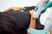 حکم شرعی لیزر بیکینی + نظر مراجع مختلف تقلید